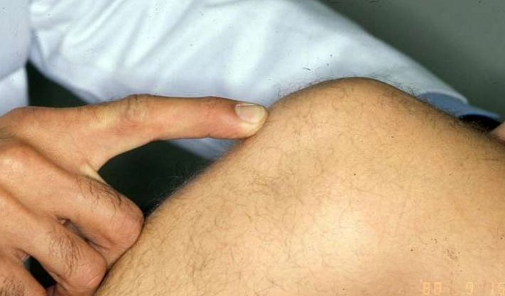 crepitus knee treatment